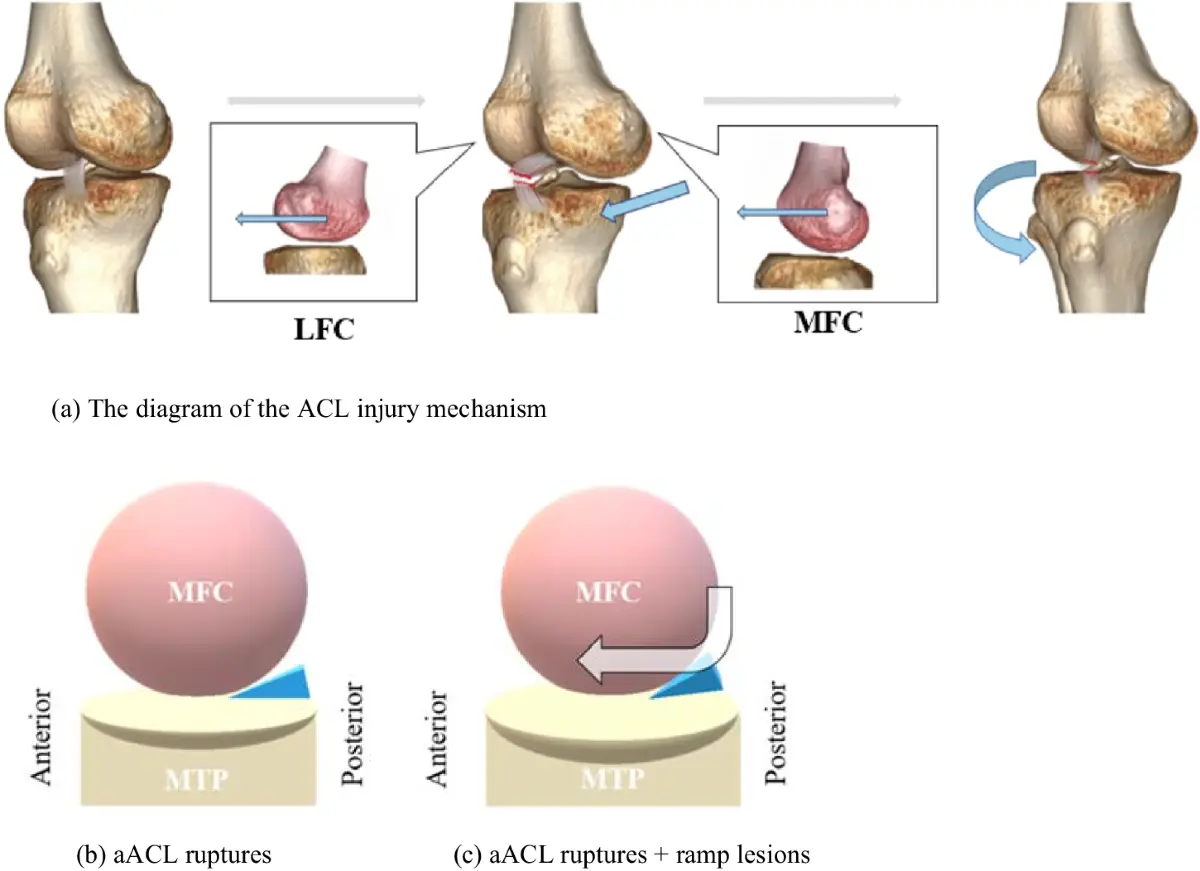 Understanding ACL Injury: Causes, Treatments, and Recovery