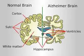 Recent Breakthroughs in Alzheimer’s Disease Research