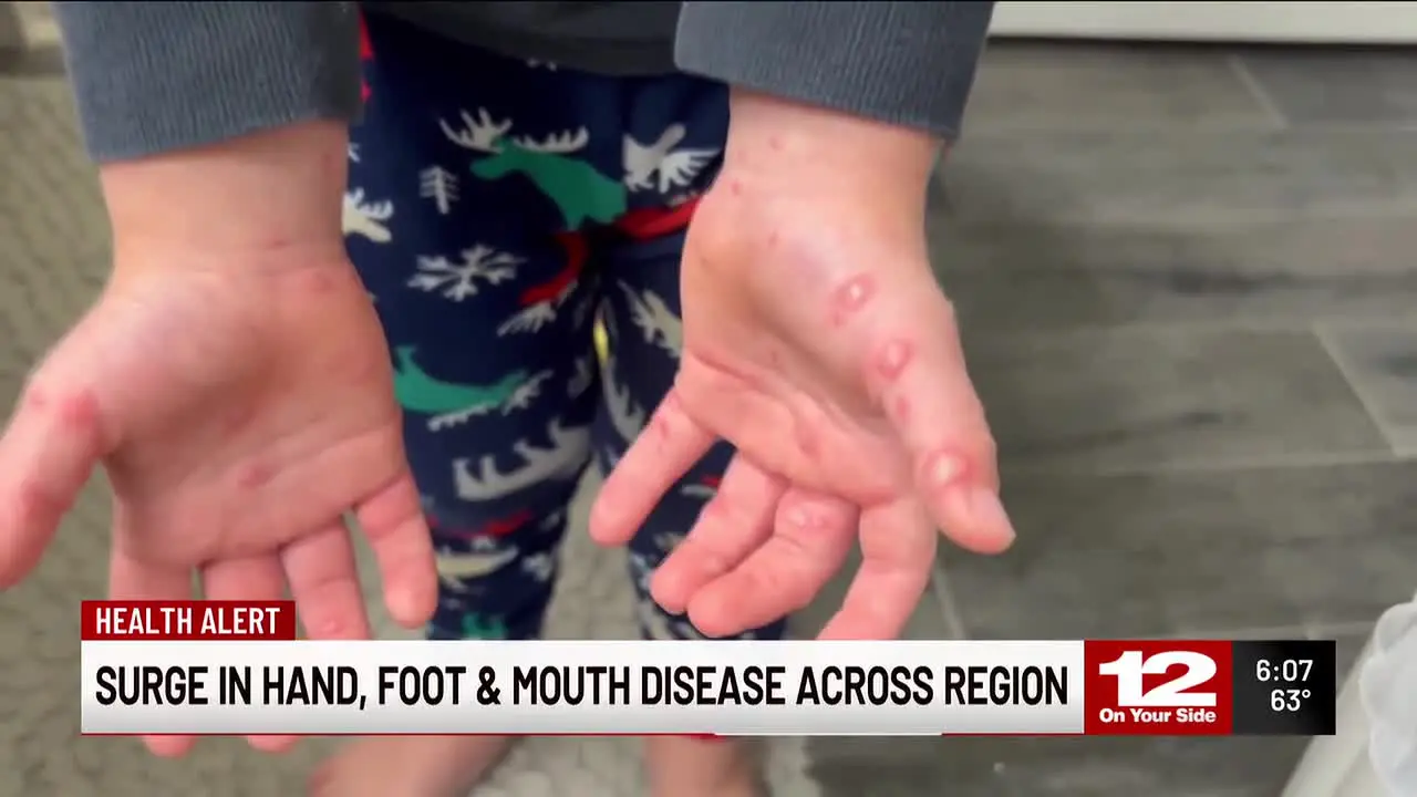 Understanding the HFMD Outbreak in Tennessee