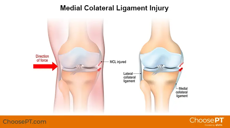 MCL Injury: A Comprehensive Overview and Recovery Guide