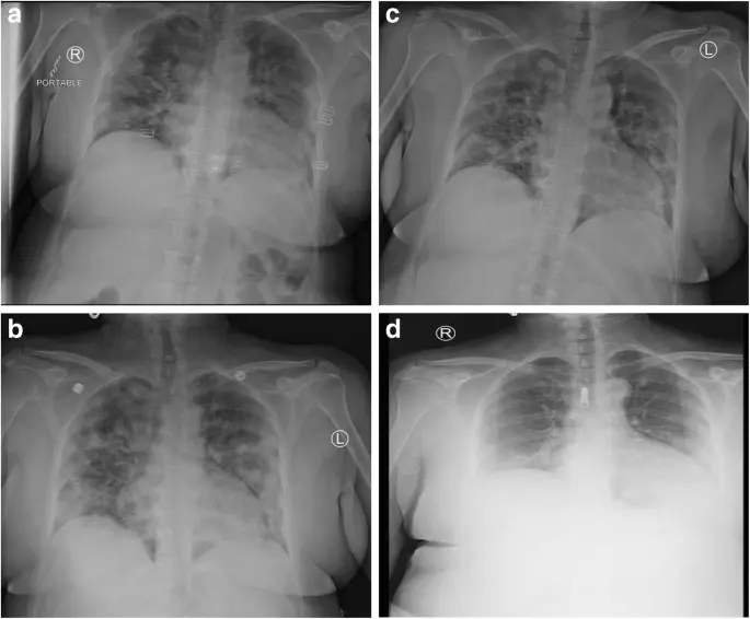 What You Need to Know About Pneumonia: Symptoms and Treatment
