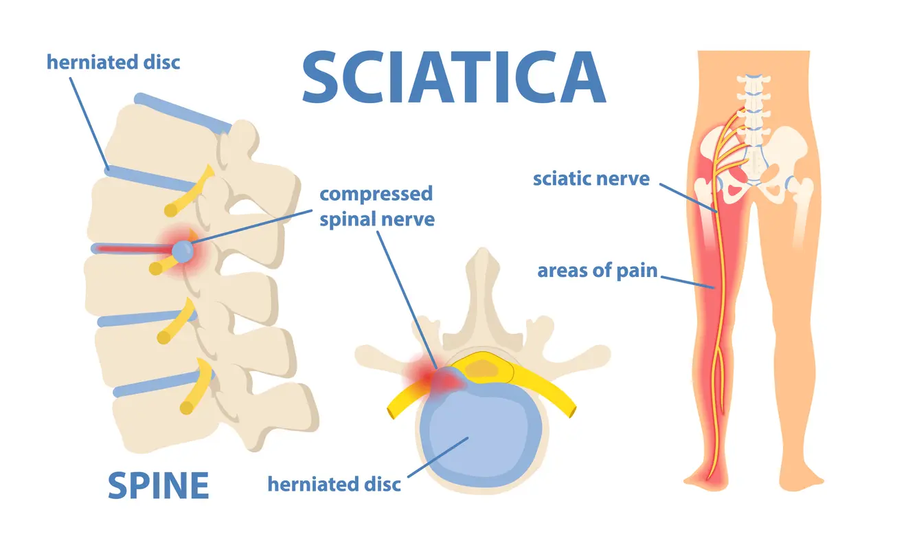 Understanding Sciatica: Causes, Symptoms, and Treatments