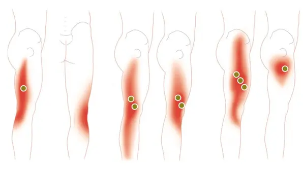 Exploring Trigger Points: Causes, Effects, and Treatments
