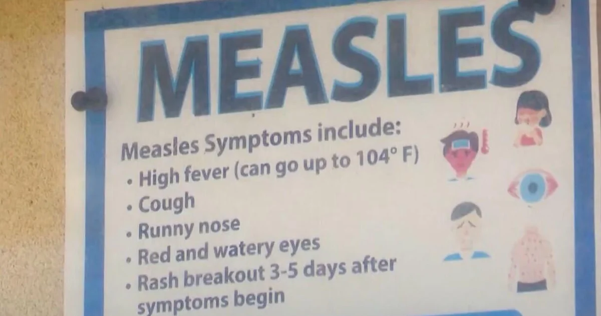 Recognising Measles Symptoms: A Crucial Guide