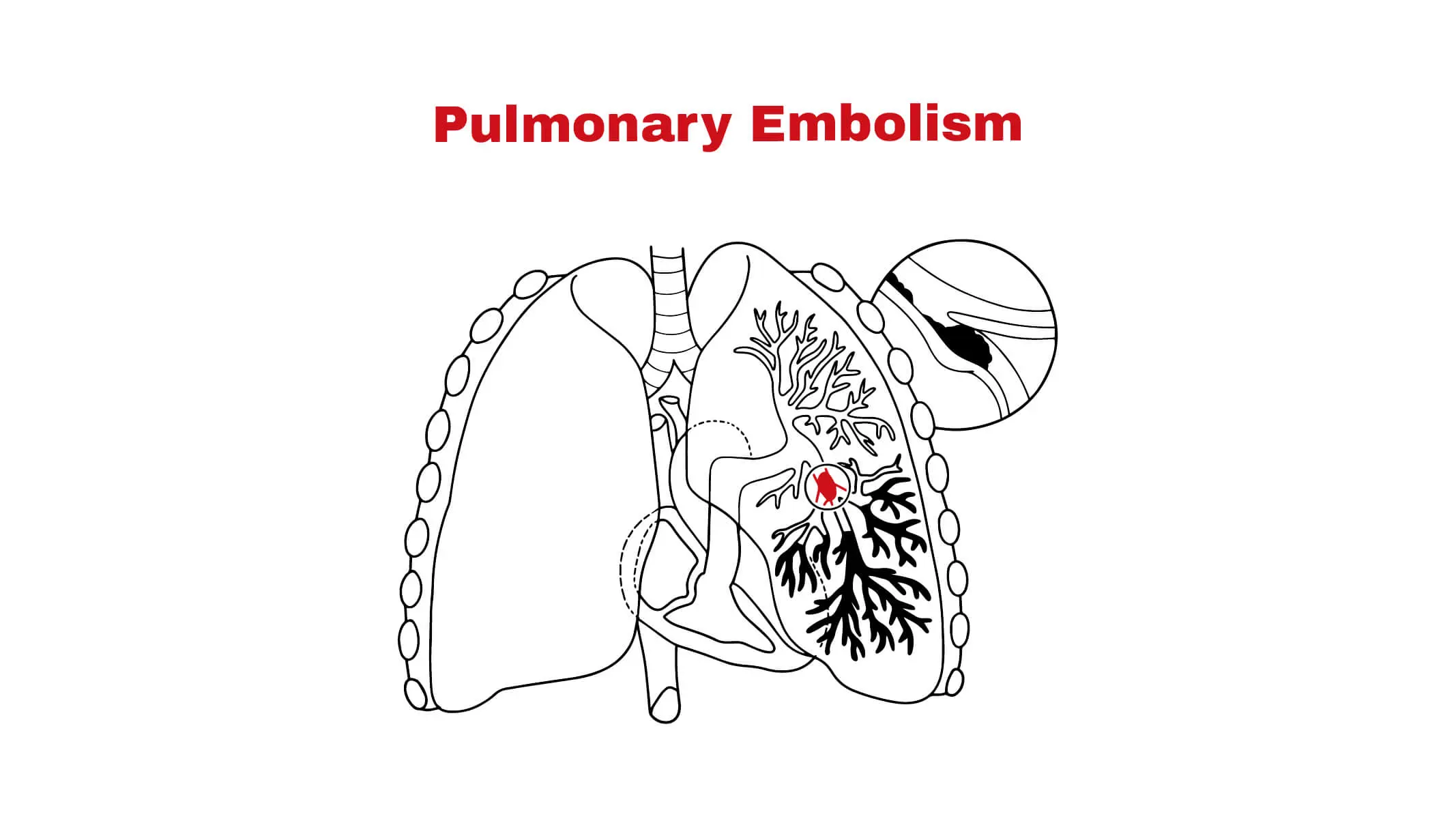 Pulmonary Embolism: Causes, Symptoms, and Treatments