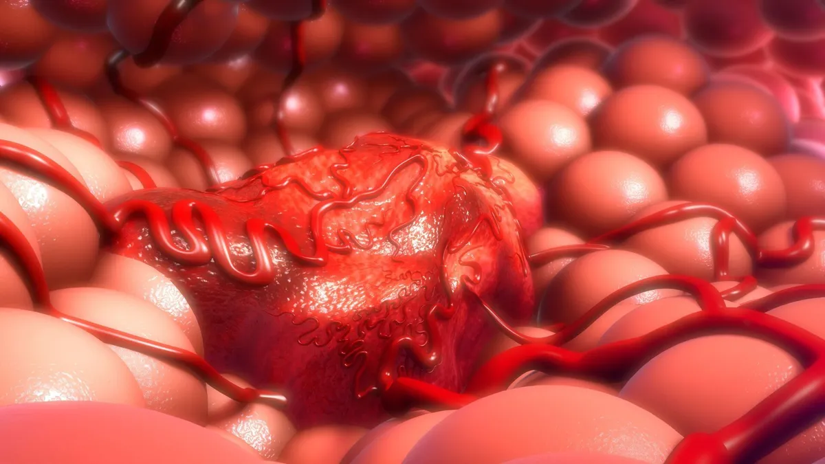 Cancer colorectal: Update on  Trends in the United States