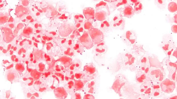 Dangerous bacterial infection in canada: What is the Current Situation of ?