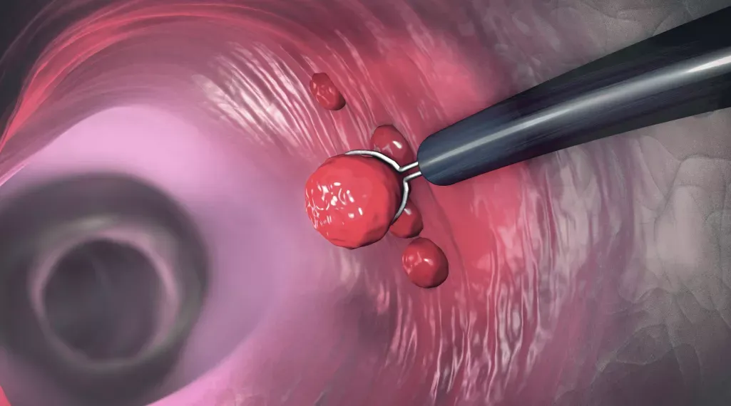 Colorectal cancer: How Does Pesticide Exposure Relate to ?